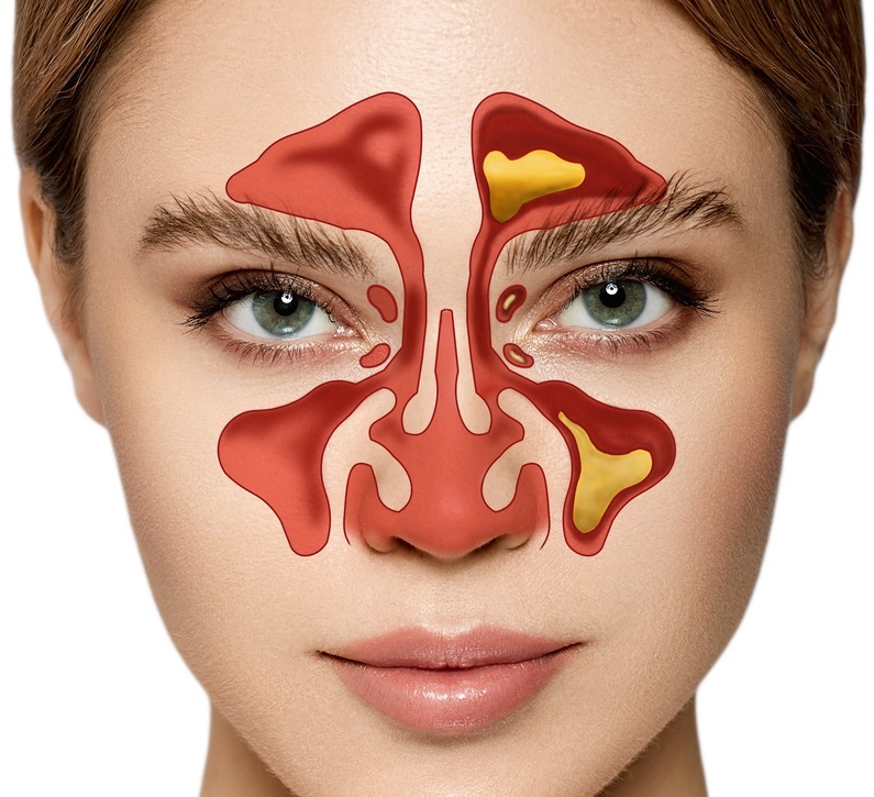 Can Sinus Pressure Cause Facial Pain